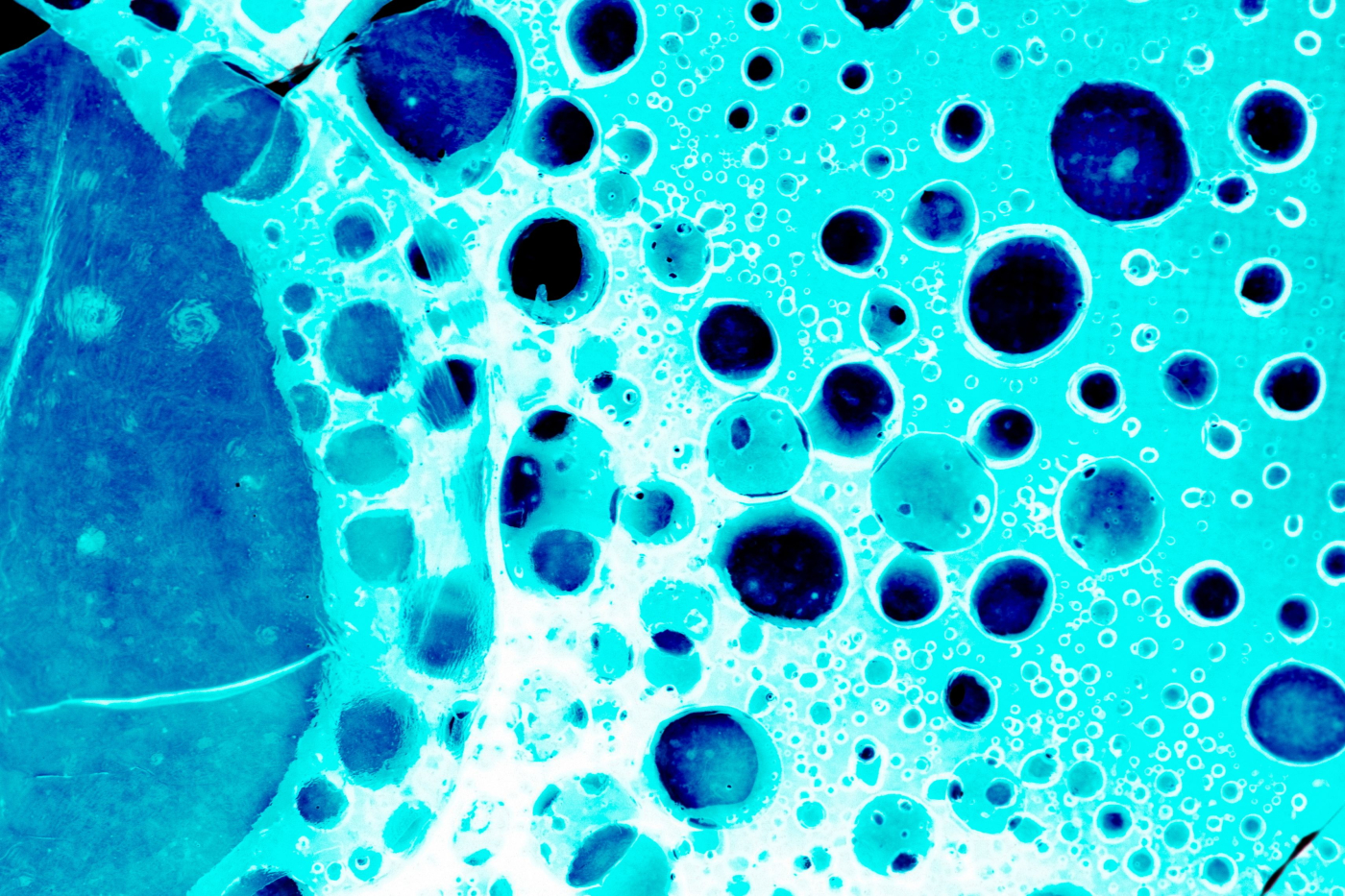 Understanding the stages of lung cancer