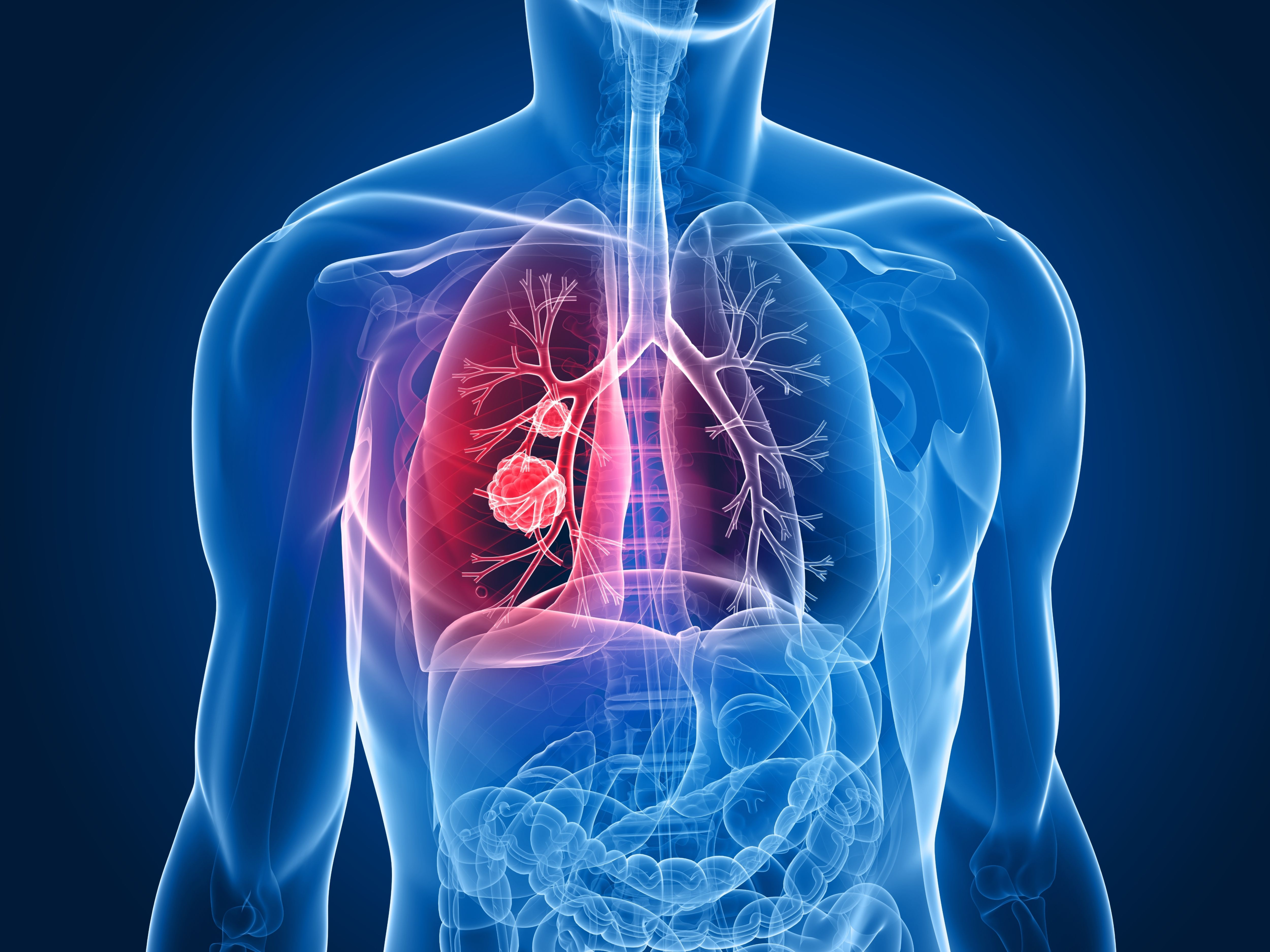 9 signs of lung cancer you should not ignore