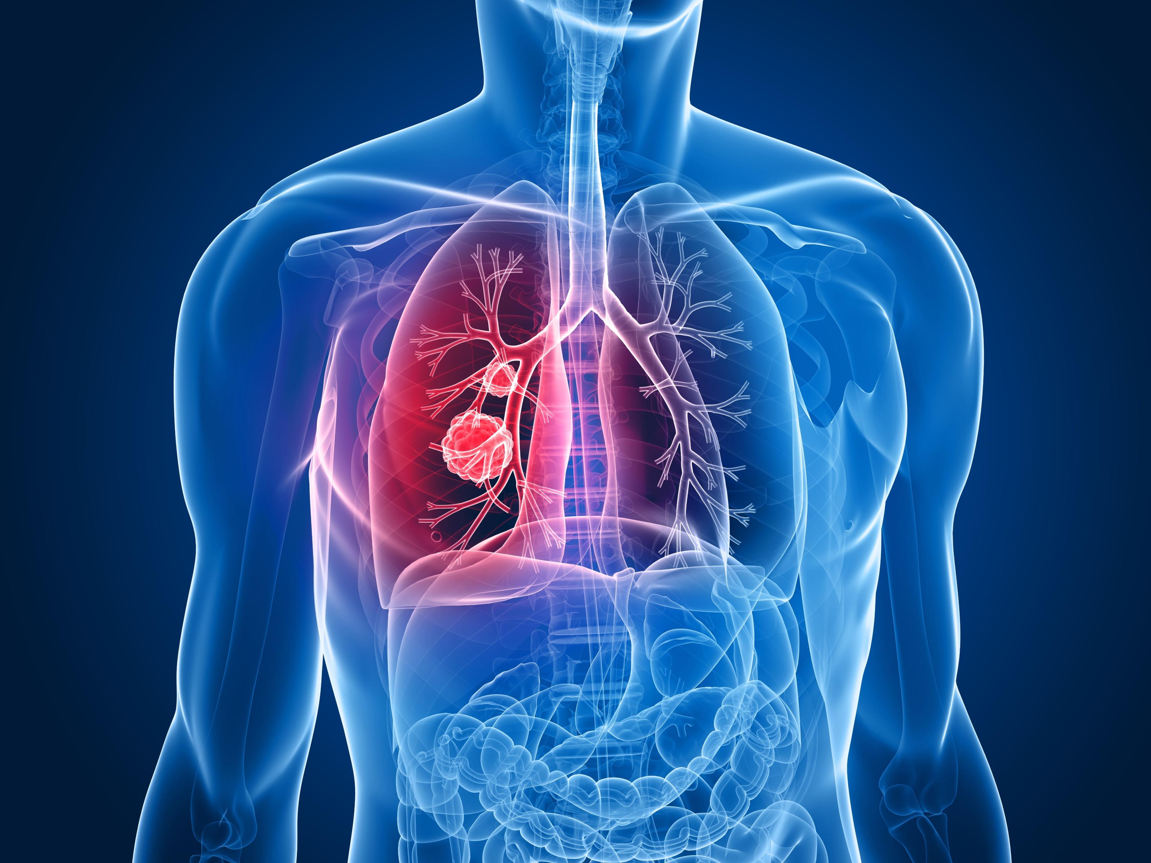 9-signs-lung-cancer-not-ignore