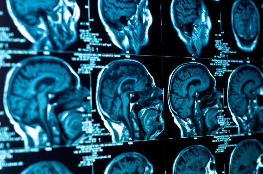 Brain Tumor: From Benign to Malignant