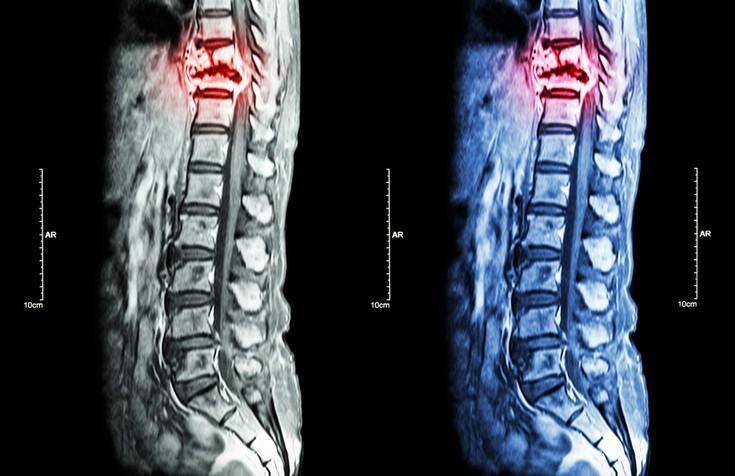 Kanser Payudara: Ketahui Mengenai Metastasis Tulang?