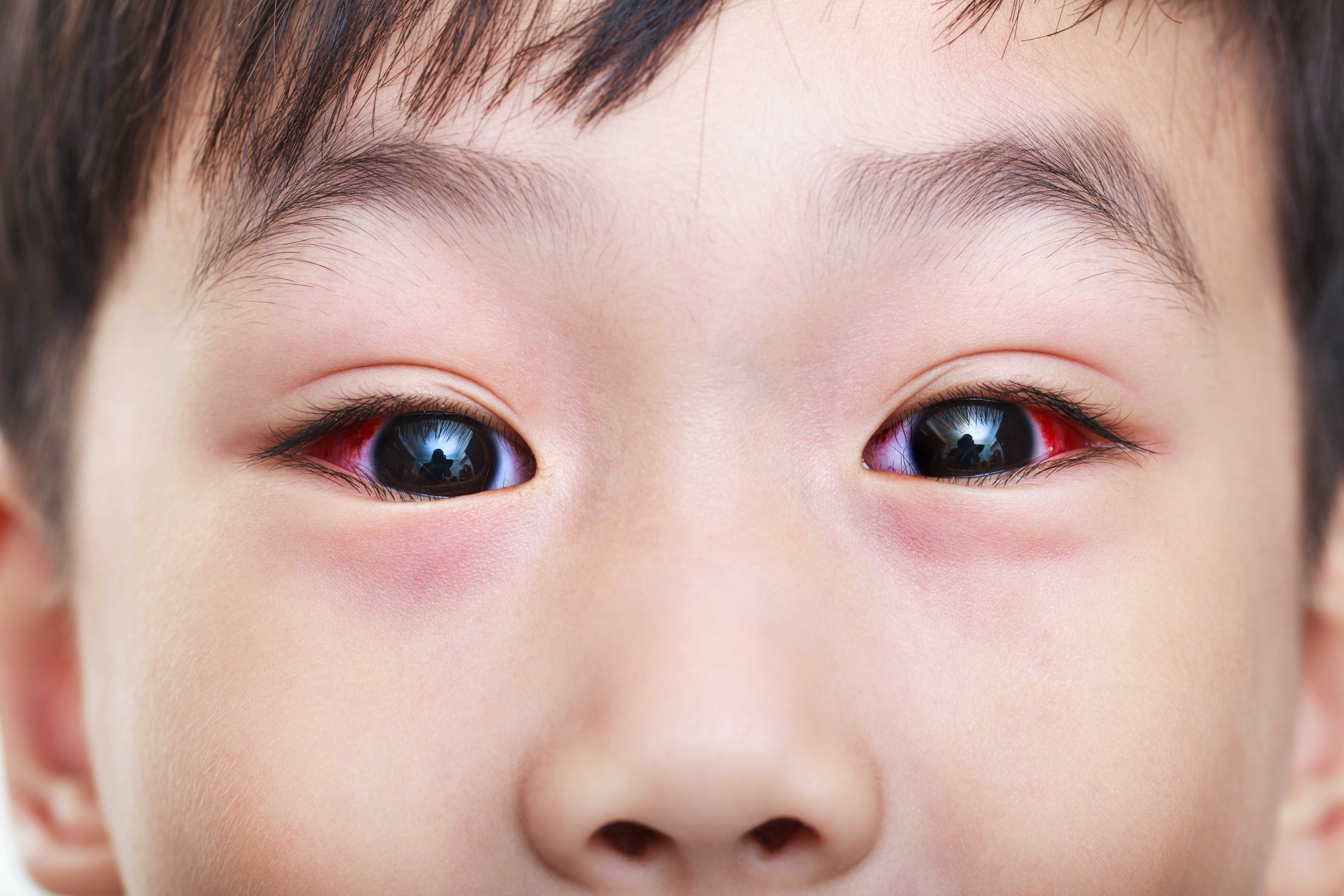 What is Allergic Conjunctivitis and Allergic Vasculitis?