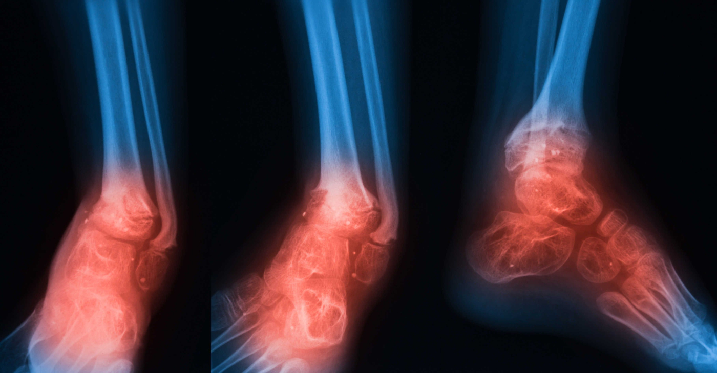 Jangkitan Tulang (Osteomielitis): Perkara Yang Harus Anda Tahu