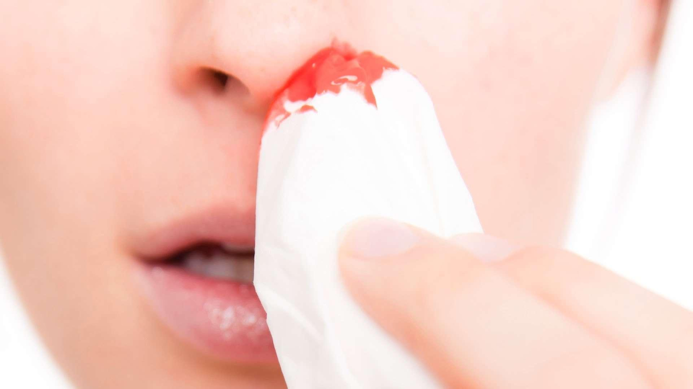 Bagaimana Ingin Merawat Hidung Berdarah Dengan Segera?