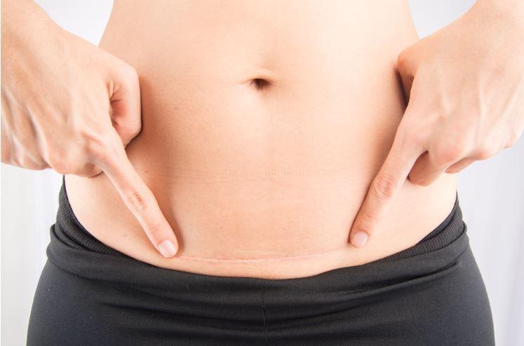Persediaan untuk Pembedahan C-section