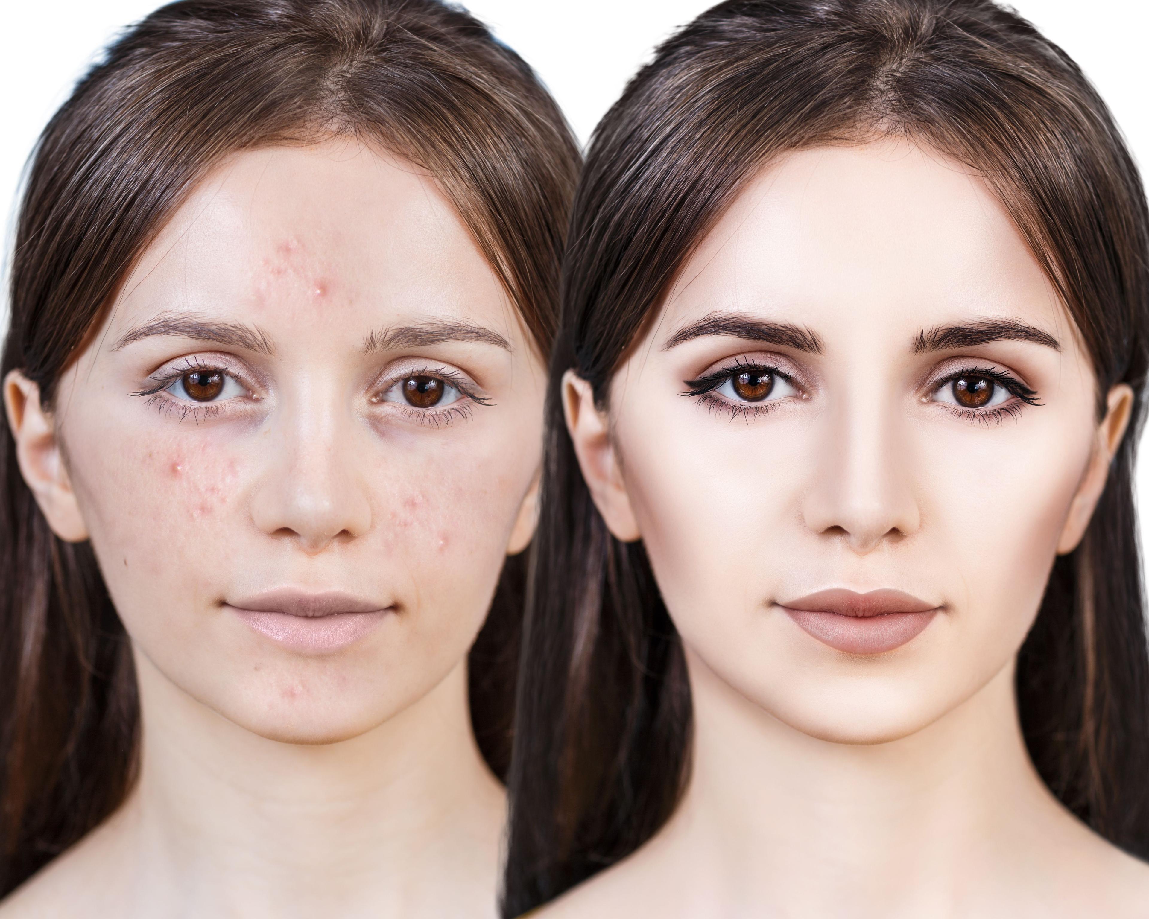 get-rid-stubborn-acne