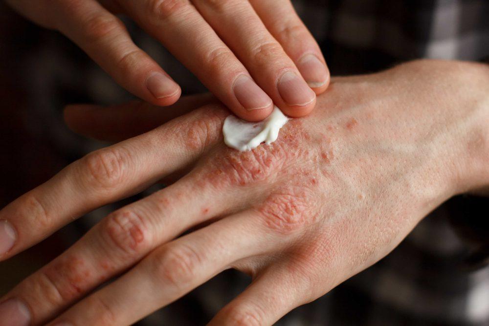 Why You Should Not Be Worried About Biologic Treatment for Psoriasis