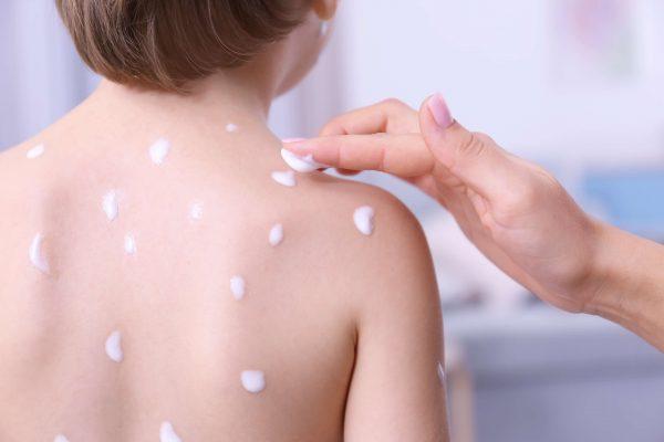 Tip Rawat Cacar Air pada Anak