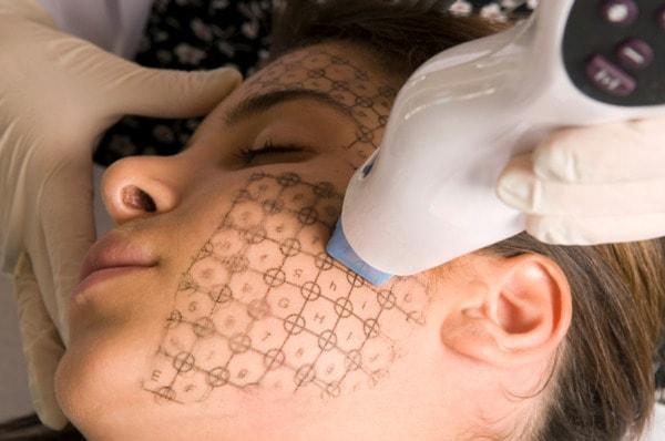 Treatment for Melasma