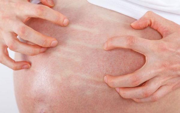 Kegatalan Melampau Akibat Cholestasis Ketika Mengandung