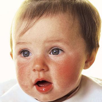 Slapped Cheek Syndrome (Part 2)