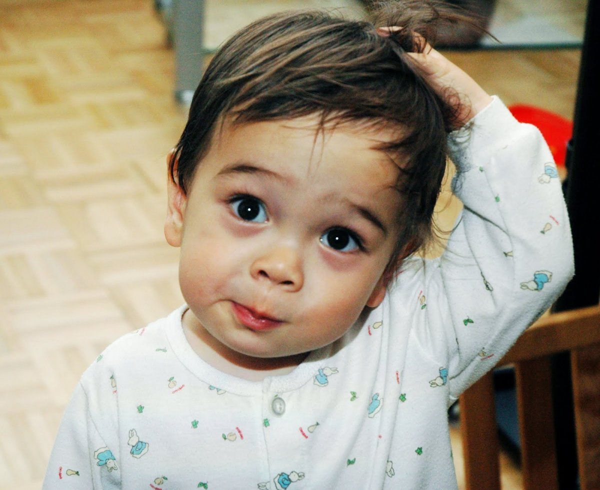 Hair Loss in Children