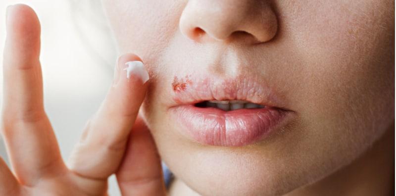 herpes-oral