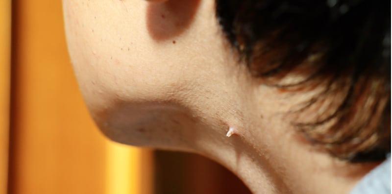 Papillomavirus manusia (hpv)