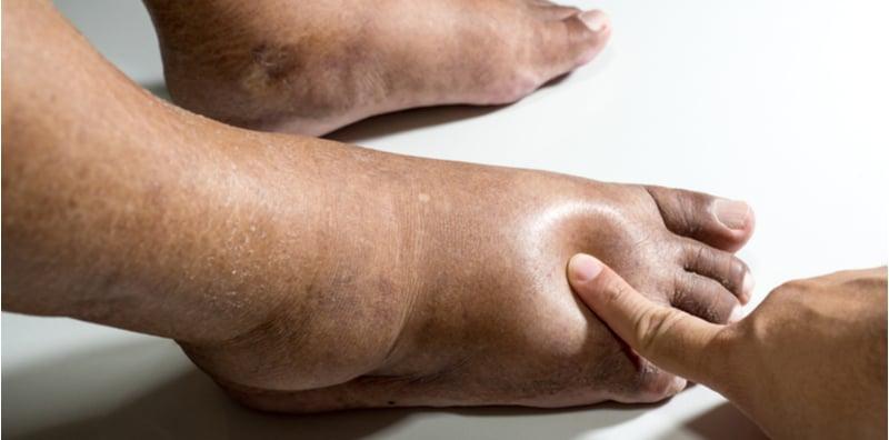 penjagaan-diabetes-cara-elak-komplikasi