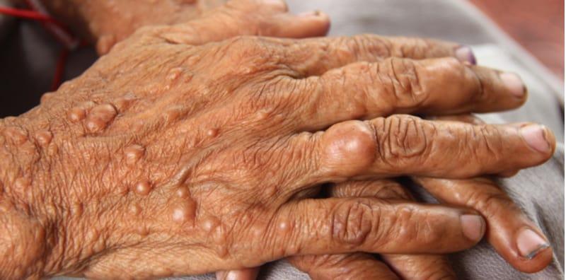 Ini Apa Yang Anda Perlu Ketahui Mengenai Neurofibromatosis Jenis 1