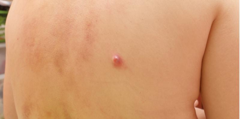 Kenapa Badan Selalu Naik Bisul? Ini 6 Punca Bisul Sebenarnya!