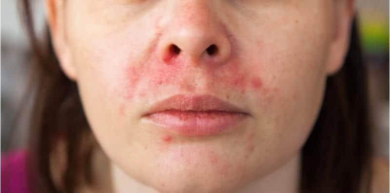 Dermatitis Atopik