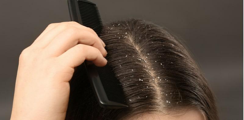 Tak Perlu Ubat Rambut, Ini 10 Cara Semula jadi Untuk Merawat Kelemumur Teruk, Sangat Berkesan!