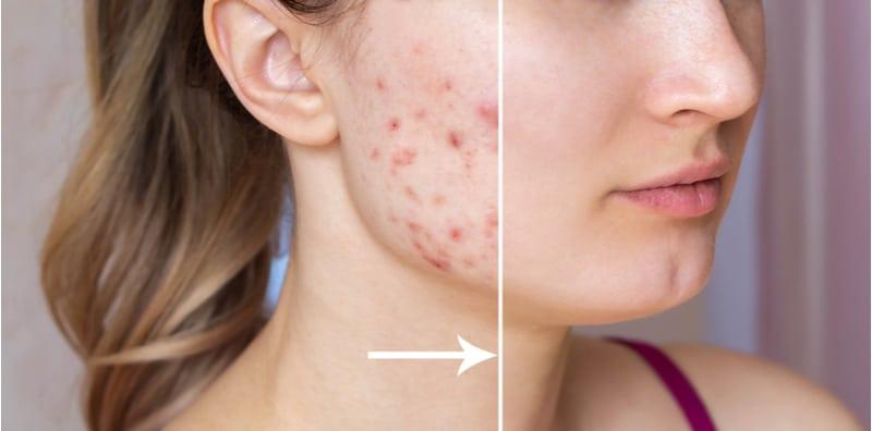 makanan-untuk-parut-jerawat