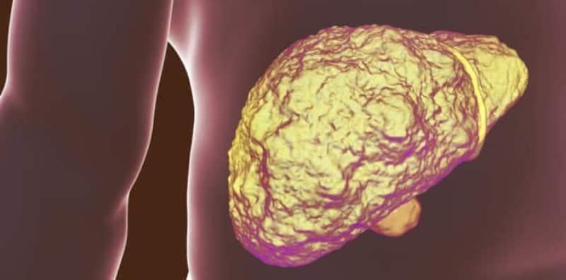 penyakit-sirosis-hati-alkoholik