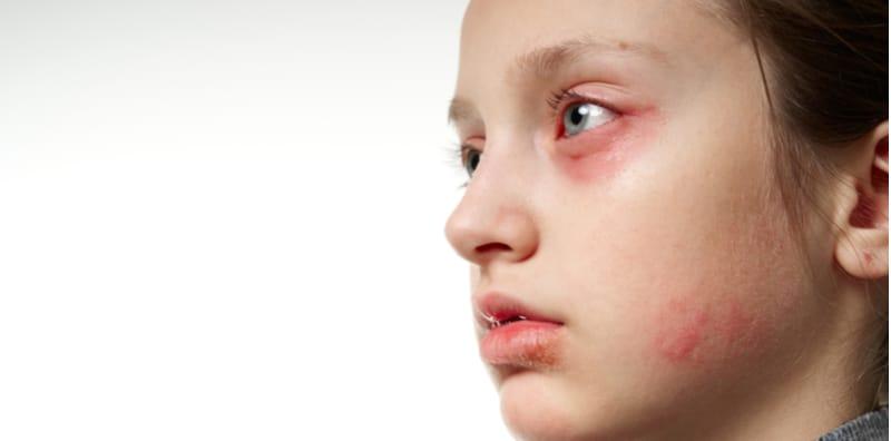 Tanda Alergi Yang Muncul Tak Boleh Dibuat Main, Komplikasi Teruk Boleh Membawa MAUT!