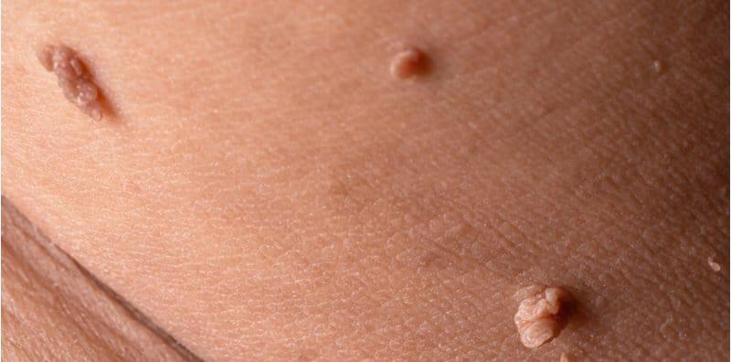 Kutil Penuh Di Badan? Ini Cara Hilangkannya Yang Boleh Dicuba