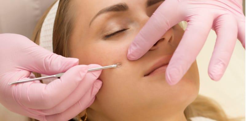 Alamak! Banyaknya Bintik Hitam Dekat Muka, Ini Cara Berkesan Untuk Singkirkan Blackhead