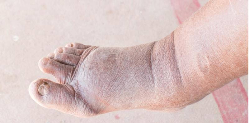 Bengkak Kaki Anda Mungkin Kesan Nefropati Diabetes, Ini Maklumat Lanjut Mengenainya...