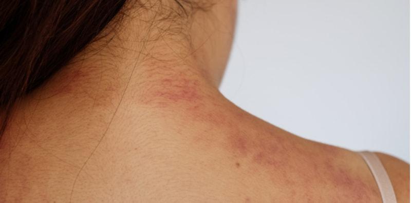 Info Lengkap Tentang Alahan Ubat