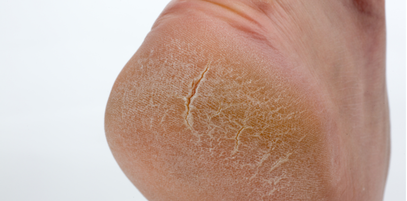 rawat-kulit-mengelupas-dan-merekah