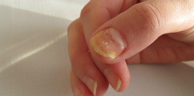 5-cara-merawat-kuku-rapuh