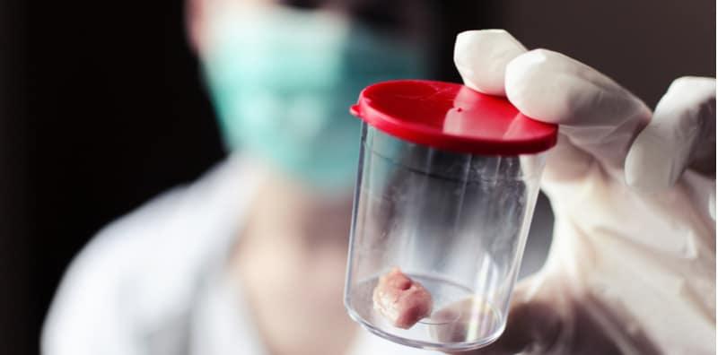 Ini Yang Anda Perlu Ketahui Mengenai Biopsi Paru-paru!