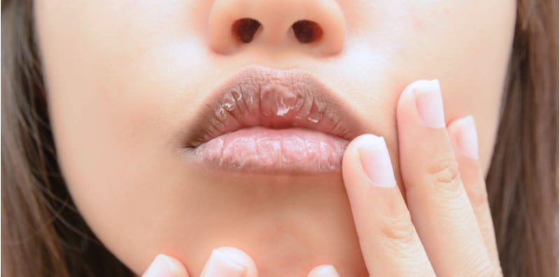 Bibir Terlalu Kering Dan Menggelupas, Ini 5 Tip Yang Boleh Mengatasi Masalah Itu