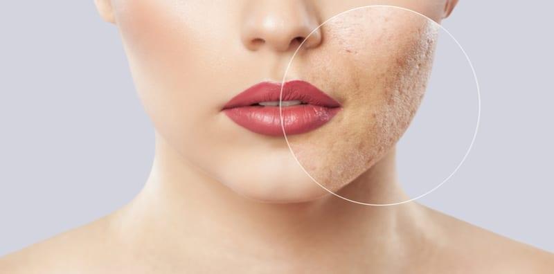 cara-merawat-masalah-jerawat-yang-teruk