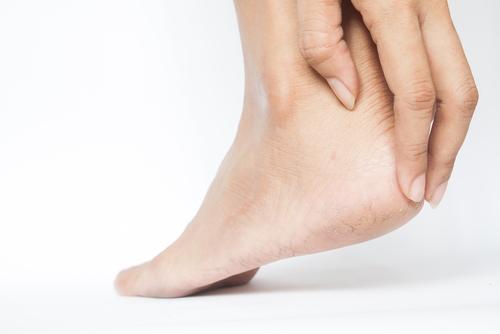 rawatan-semula-jadi-bagi-tumit-pecah