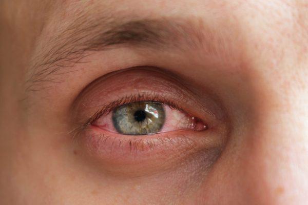 5 Sebab Mata Berair Yang Kerap Berlaku