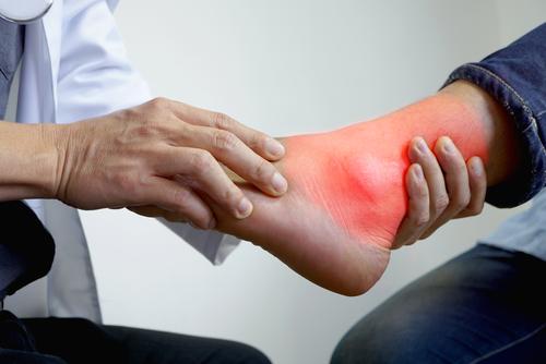 Tip Penjagaan Kesihatan Pesakit Gout Semasa Ramadan