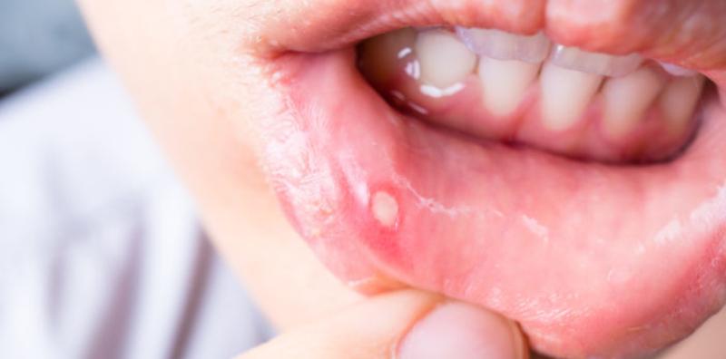 5-punca-biasa-ulser-mulut