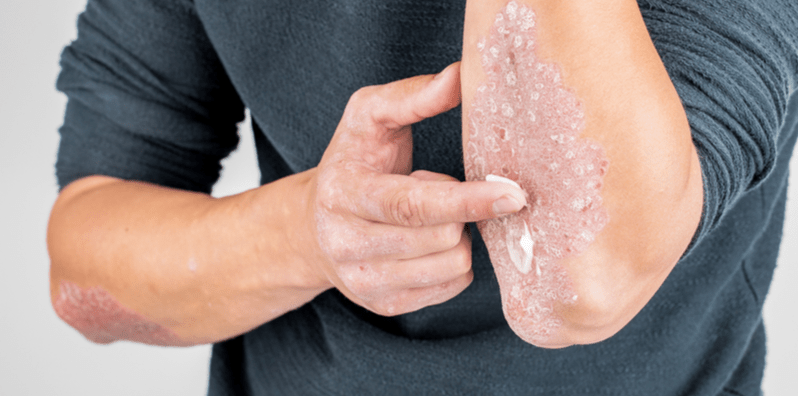 Cuba 5 Cara Mudah & Efektif Ini Untuk Merawat Psoriasis Secara Semula Jadi!