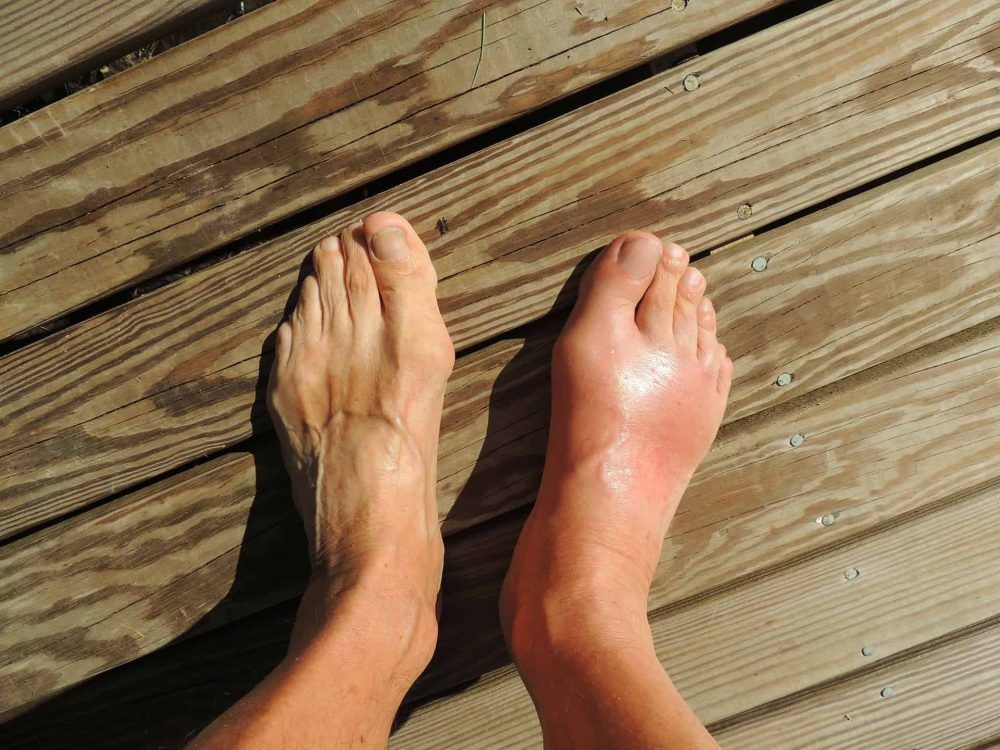 Gout: Kesengsaraan Bagi Penghidapnya