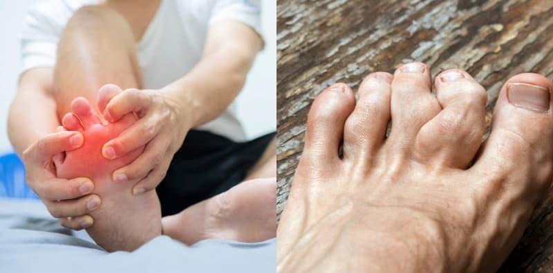 Gout dan Artritis Reumatoid: Apa Yang Anda Perlu Tahu?