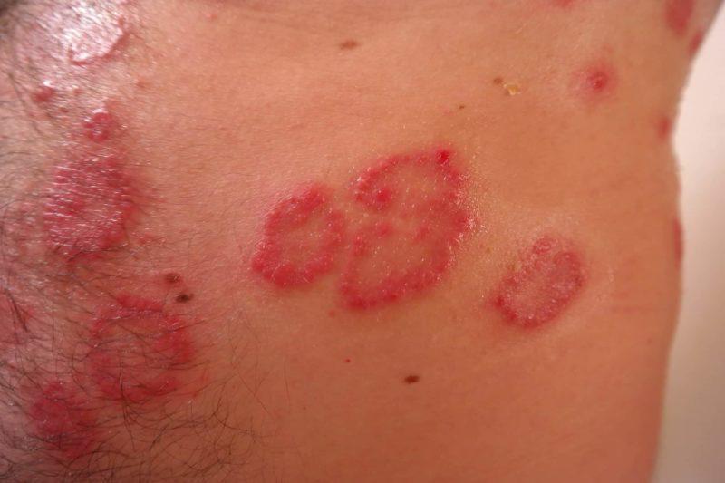 Sarkoidosis: Tompokan Merah dan Pembengkakan Tisu Organ Tubuh