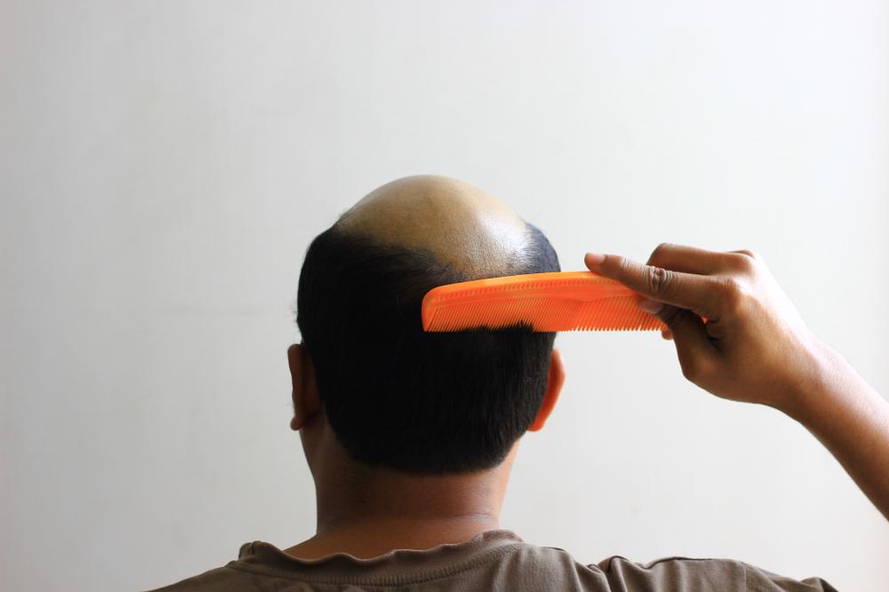 Mengapa Rambut Botak lebih Kerap Berlaku dalam Kalangan Lelaki?