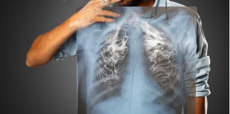 paru-paru-rosak