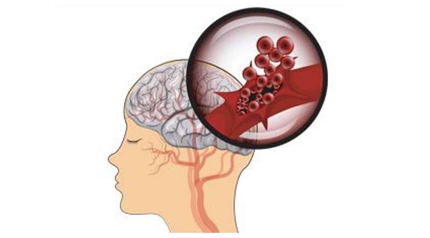 bagaimana-hipertensi-menyebabkan-strok