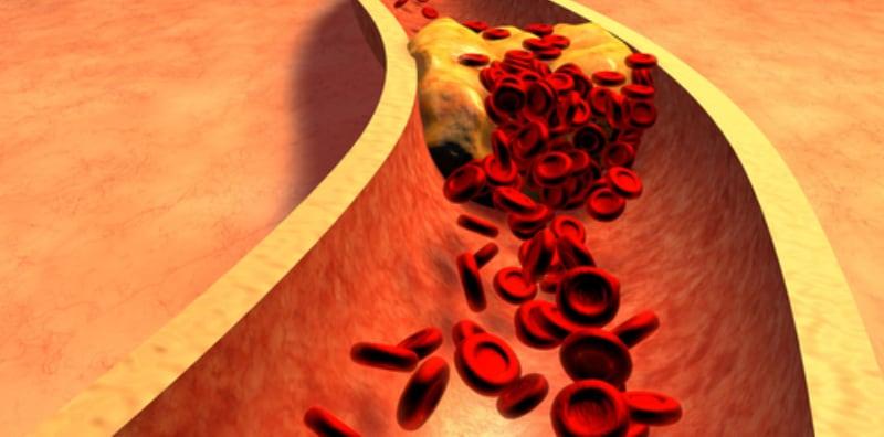 5 Penyakit Yang Berisiko Terjadi Jika Anda Ada Kolesterol Tinggi Dalam Badan!