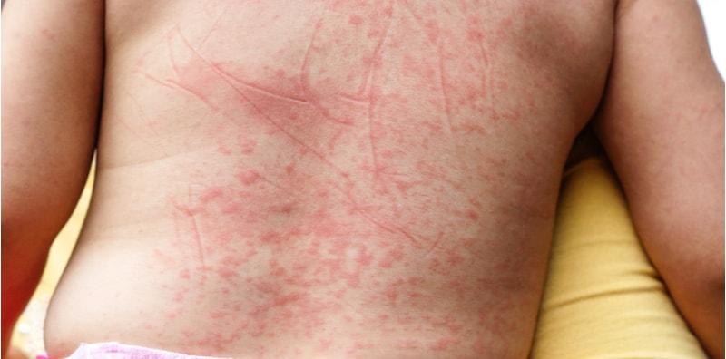 Denggi: 5 Soalan Lazim Mengenainya