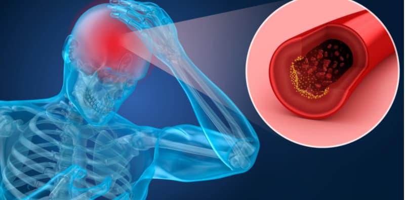 Mencegah Lebih Baik Dari Mengubati, Kenali 7 Punca Strok Yang Anda Mungkin TAK Tahu Ini!