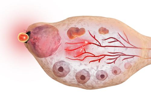 Simpanan Ovum dan Ujian AMH